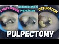 Pulpectomy  access opening  chemomechanical preparation  obturation  pulpectomy procedure 84