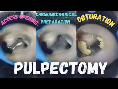 Pulpectomy | access opening | chemomechanical preparation | obturation | pulpectomy procedure #84