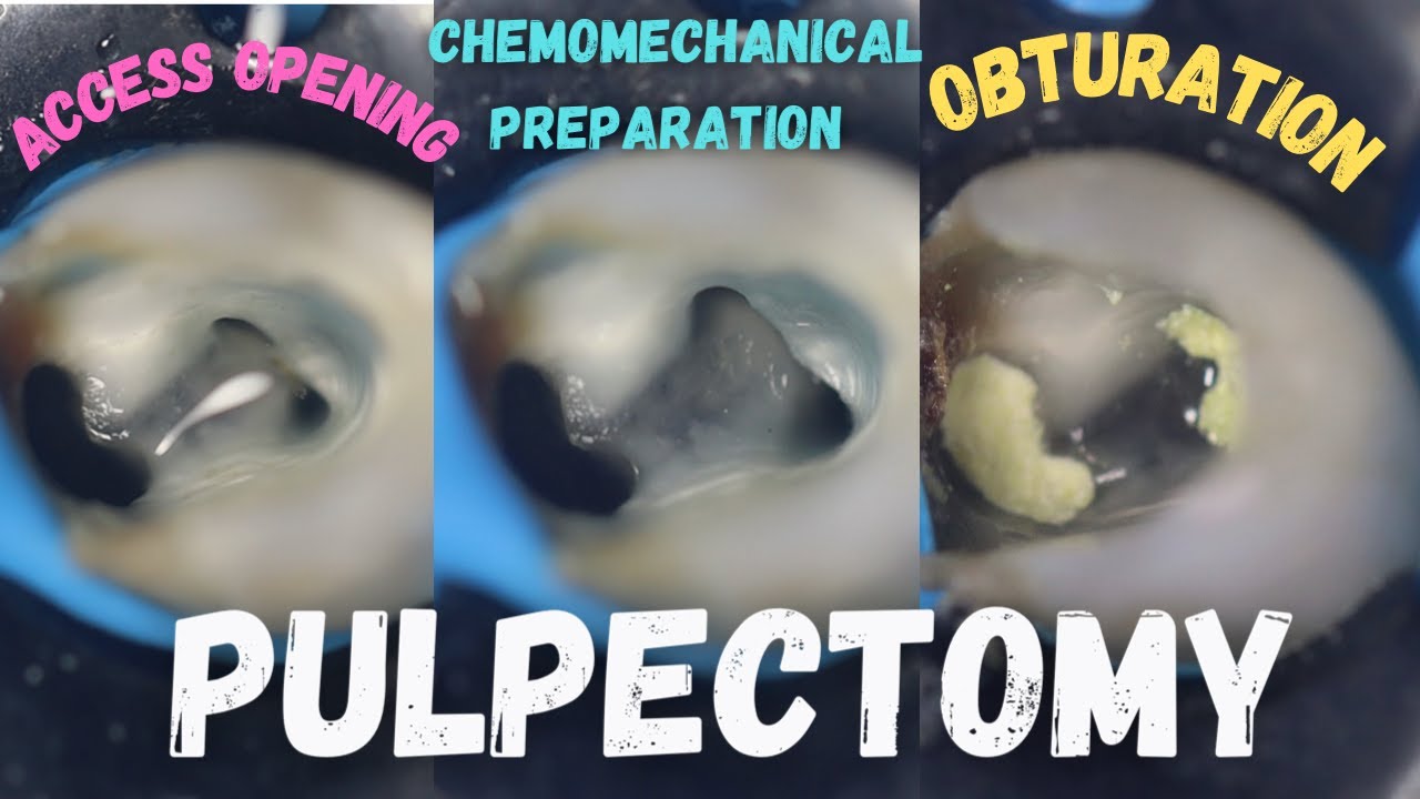 Pulpectomy access opening chemomechanical preparation obturation