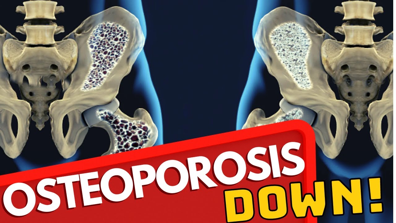 5 Natural Ways to Increase Bone Density, Bones and Osteoporosis YouTube