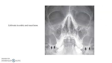 Nasal Bones & Orbits