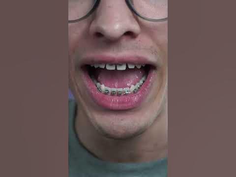 SHOCKING: Eating Chocolate with Braces - YouTube