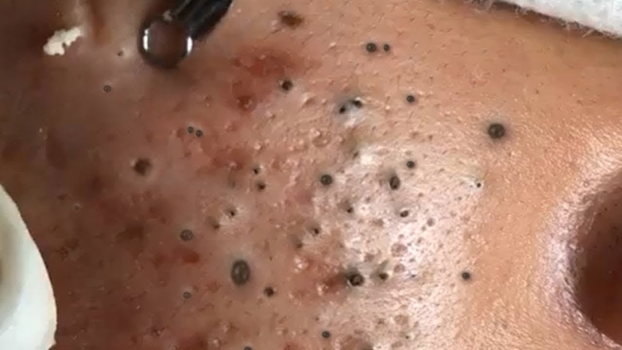 Big Cystic Acne Blackheads Extraction Blackheads And Removal Pimple