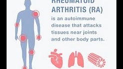 Rheumatoid Arthritis