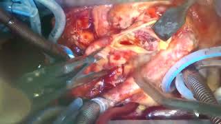 Commando Procedure with Subannular Circumferential Reconstruction for Root Abscess in a TAVR Patient