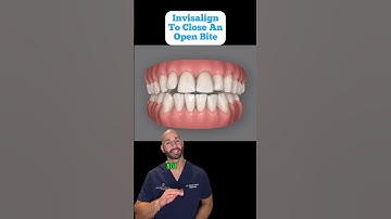 Can Invisalign Fix An Open Bite? Smile Design Simulation Of An Actual Patient. (2023)