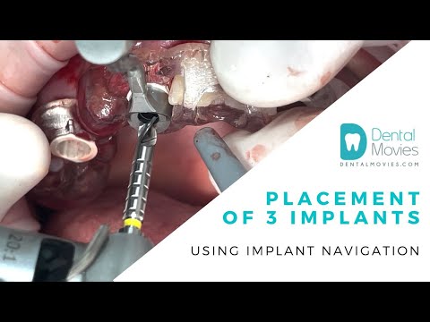 Placement of 3 implants using implant navigation. ??