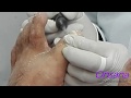 Podología profesional - tratamiento de uñas micóticas