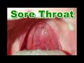 Normal vs sore throat  pharyngitis