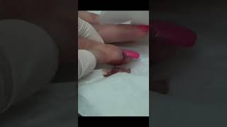 Dr Gilmore Nail Treatment, Paronychia?