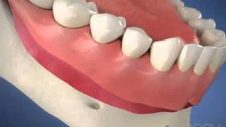 Dentures Denture Problems