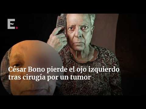 César Bono Awaits Biopsy Results After Losing His Left Eye