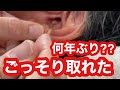 何年かぶりの耳掃除かと勘違いするほどごっそり取れた耳の垢（理容師チャンネル）