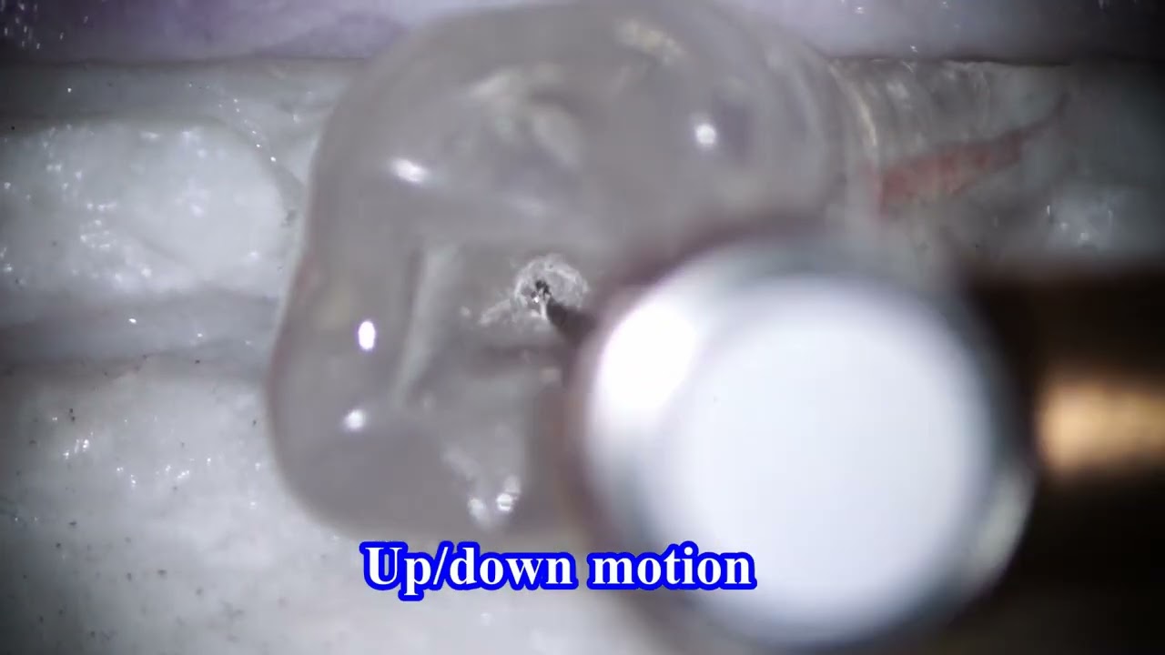 Basic broken file removal/基本的な破折器具除去