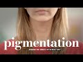 PIGMENTATION around your mouth? We have the best tried and tested remedies! | Facial Pigmentation