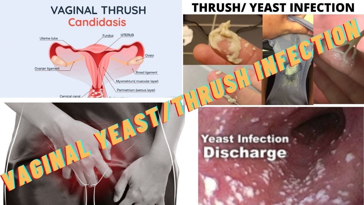 vaginal yeast infection discharge