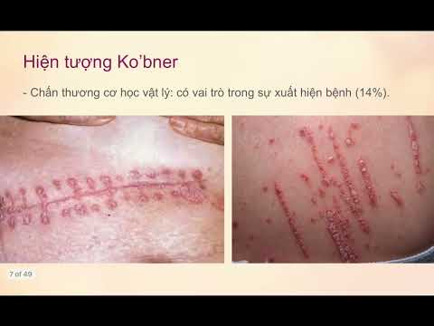 Video BỆNH VẢY NẾN I BỆNH LÍ DA LIỄU I Y5 - YouTube