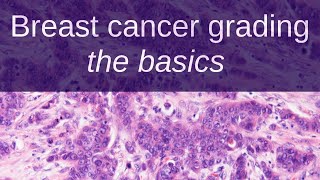 How to Grade Breast Cancer - The basics