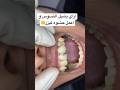 كيفية ازالة التسوس و عمل حشوة ليزر تجميلي😍 how to remove caires #teeth  #restoration #caries