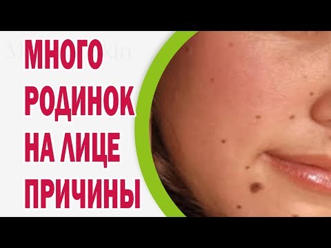 Удаление папиллом в рязани лазером цены