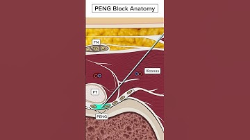 Ultrasound Guided Nerve Blocks