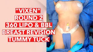 VIXEN HOURGLASS TRANSFORMATION! Round 2 - 360 Lipo & BBL with Breast Revision and Tummy Tuck!