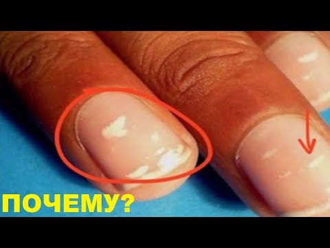 Белые пятна на ногтях? Почему появляются белые пятна на ногтях и как их убрать?