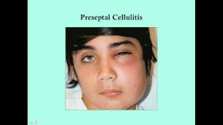 Preseptal and Orbital Cellulitis - CRASH! Medical Review Series screenshot 4