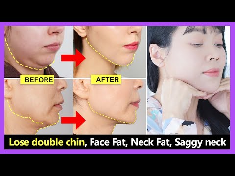 Video: How To Get Rid Of Neck Fat Naturally: 10 Diet Tips And 6 Exercises