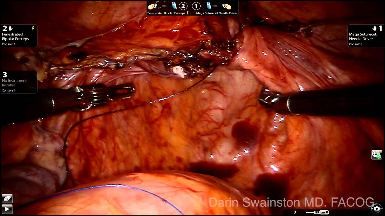 Isoflurane During Prolonged Anaesthesia With Special Reference To Liver Function