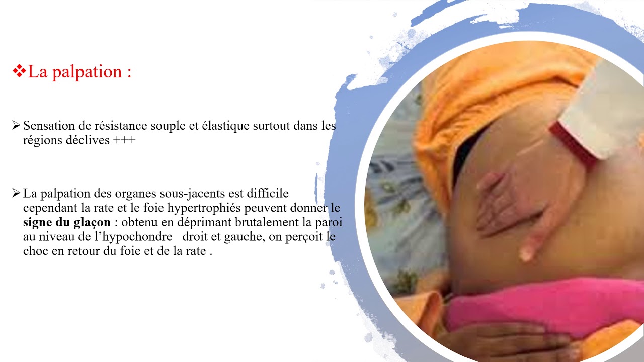 Les ascites ( Troisième année médecine )