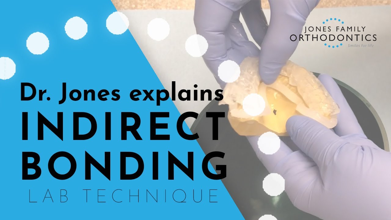 Dr. Jones Explains Indirect Bonding How it's Made Jones Family