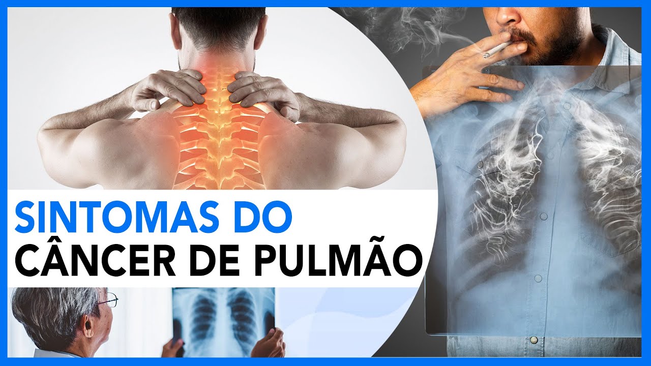 Sintomas do Câncer de Pulmão YouTube Sintomas do Câncer de Pulmão YouTube