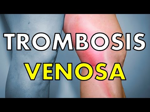 Vídeo: Trombosis Venosa Profunda (TVP): Síntomas, Tratamientos Y Prevención