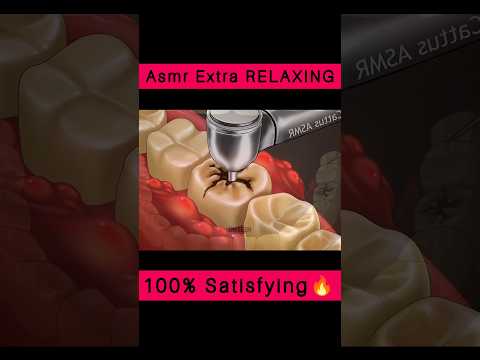 😲 ASMR Treatment 😲 Removal Tooth Decay Cleaning Animation 🔥 #asmr #animation #satisfying #shorts