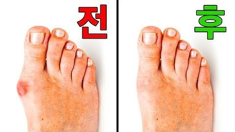 건막류로 인한 통증을 없애는 5가지 방법