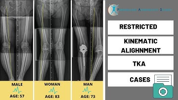 Restricted Kinematic Alignment TKA: Cases examples