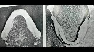 Rehabilitación Neuro Oclusal