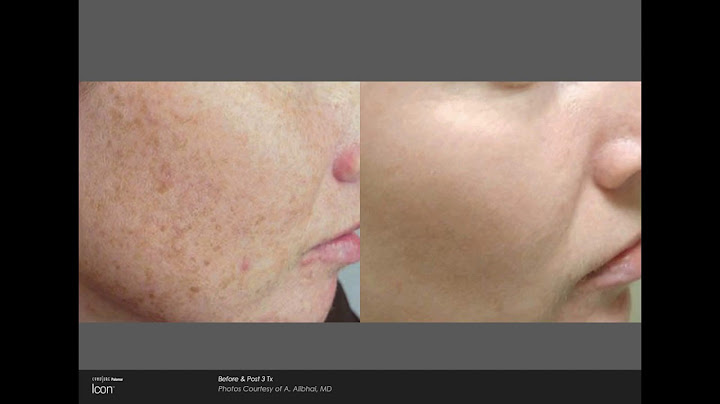 Skin tightening tempsure envi before and after