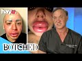 'Lip King' Wants A Smaller Nose And Doesn't Care About The Consequences | Botched