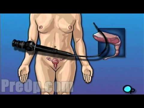 Cystoscopy Female Vaginal Surgery PreOp® Patient Education & Engagement Company