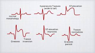 Easy ECG | Module 3 | ECG changes in coronary heart diseases