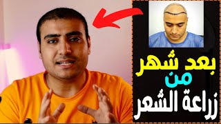 بعد شهر من زراعة الشعر للمرة التانية I برنامج البسيط