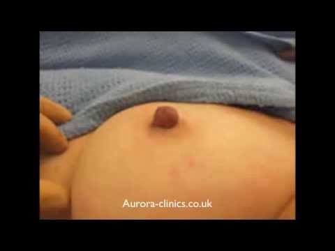 Inverted Nipple Correction