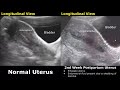 Gynecological  obstetric ultrasound normal vs abnormal scan  uterus ovary cervix pregnancy usg