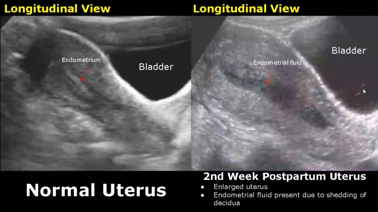 Gynecological And Obstetric Ultrasound Normal Vs Abnormal Scan Uterus