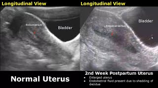 Gynecological Obstetric Ultrasound Normal Vs Abnormal Scan Uterus Ovary Cervix Pregnancy Usg