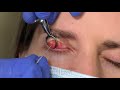 Incision and Drainage of a Chalazion/Stye