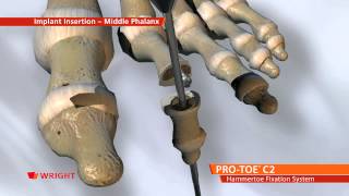 PRO-TOE™ C2 Hammertoe Fixation System Animation