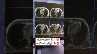 Live Heart Beat On Cardiac Mri - Lub Dub Lub Dub